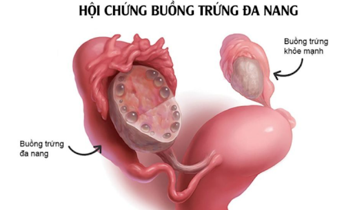 Buong-trung-da-nang-la-hoi-chung-do-mat-can-bang-hormone-trong-co-the-phu-nu